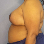 Mastopexy (Breast Lift) Before & After Patient #8402