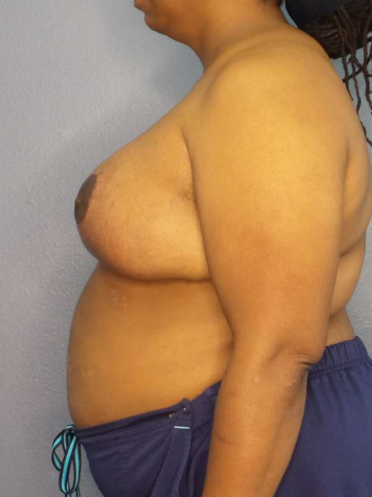 Mastopexy (Breast Lift) Before & After Patient #8402