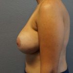 Breast Augmentation Revision (Breast Enlargement Repair) Before & After Patient #7302