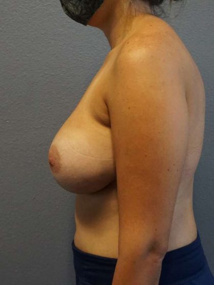 Breast Augmentation Revision (Breast Enlargement Repair) Before & After Patient #7302