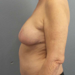 Mastopexy (Breast Lift) Before & After Patient #8377