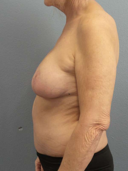 Mastopexy (Breast Lift) Before & After Patient #8377