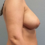 Asymmetric (Uneven) Breasts Before & After Patient #6865