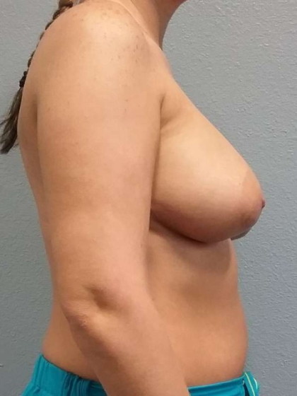 Asymmetric (Uneven) Breasts Before & After Patient #6865