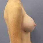 Asymmetric (Uneven) Breasts Before & After Patient #5914