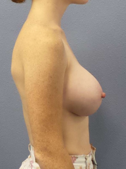 Asymmetric (Uneven) Breasts Before & After Patient #5914