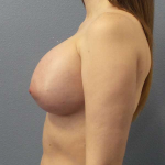 Breast Augmentation Before & After Patient #6876