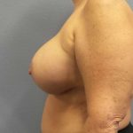 Breast Lift with Implant (Augmentation Mastopexy) Before & After Patient #4013