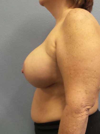 Breast Lift with Implant (Augmentation Mastopexy) Before & After Patient #4013