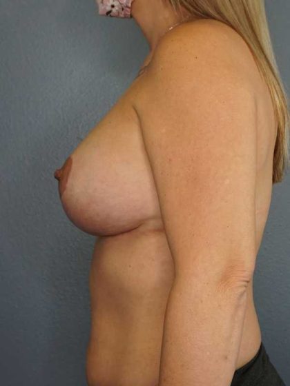 Mastopexy (Breast Lift) Before & After Patient #8403