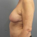 Breast Reduction Before & After Patient #7487