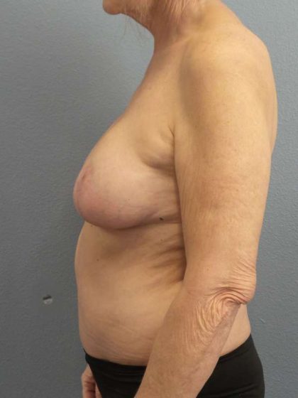 Breast Reduction Before & After Patient #7487