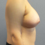 Breast Augmentation Before & After Patient #5036