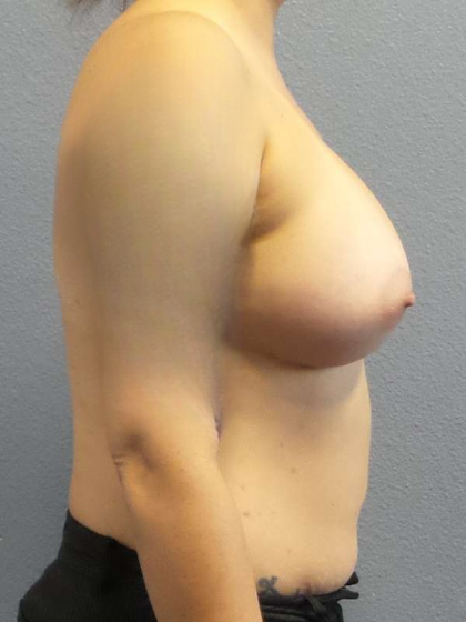 Breast Augmentation Before & After Patient #5036