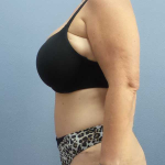 High BMI (Larger Patients) Surgery Before & After Patient #10438