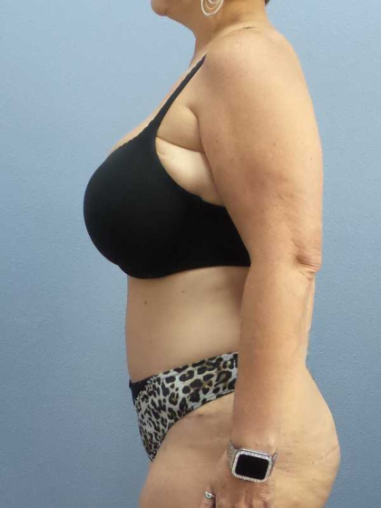 High BMI (Larger Patients) Surgery Before & After Patient #10438