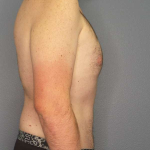 Male Liposuction Before & After Patient #3808