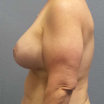 Breast Lift with Implant (Augmentation Mastopexy) Before & After Patient #4601