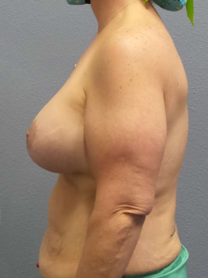 Breast Lift with Implant (Augmentation Mastopexy) Before & After Patient #4601