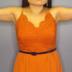 Liposuction Female Before & After Patient #7951