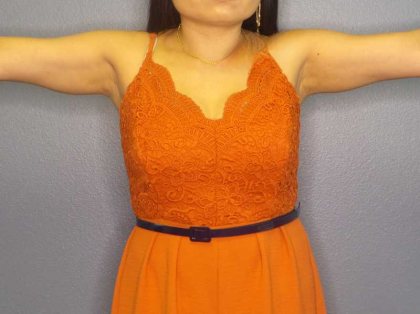 Liposuction Female Before & After Patient #7951