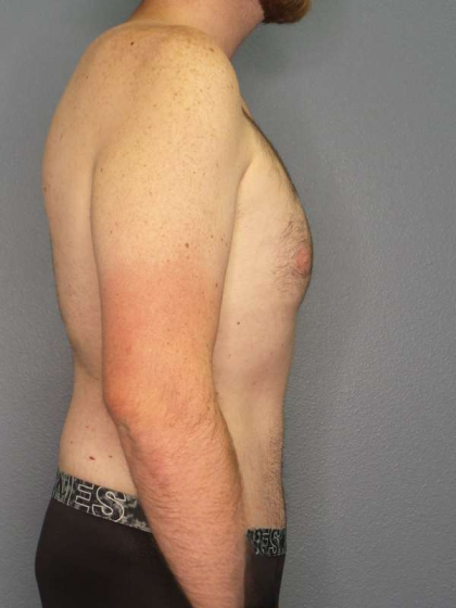 Male Liposuction Before & After Patient #3808