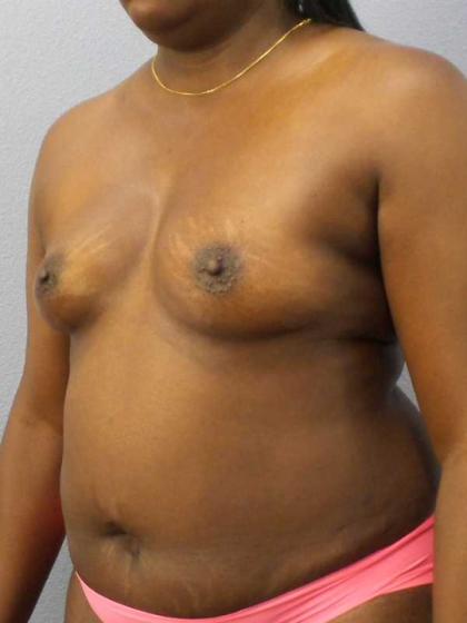 Breast Augmentation Before & After Patient #11436