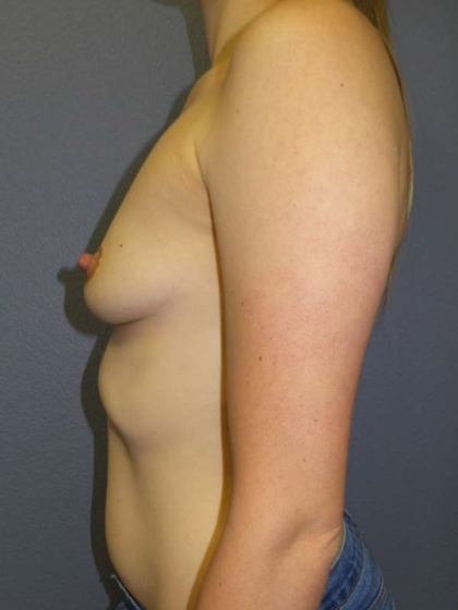 Breast Augmentation Before & After Patient #5860