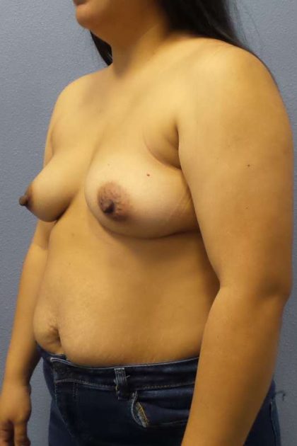 Breast Augmentation Before & After Patient #5114