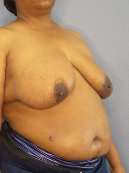 Mastopexy (Breast Lift) Before & After Patient #8402