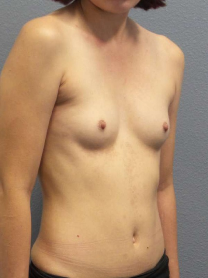 Breast Augmentation Before & After Patient #6760