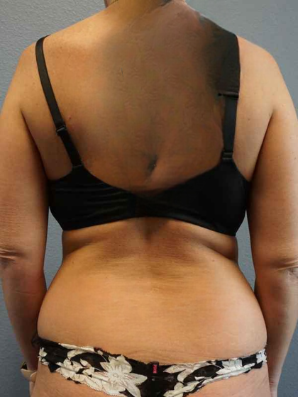 Liposuction Female Before & After Patient #8101