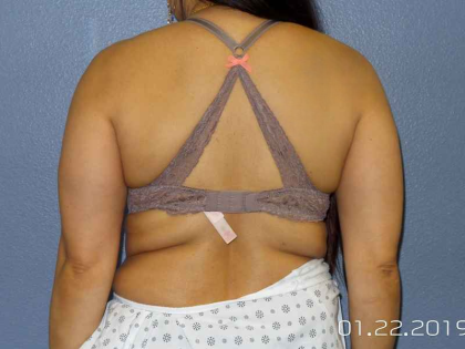 Liposuction Female Before & After Patient #7951