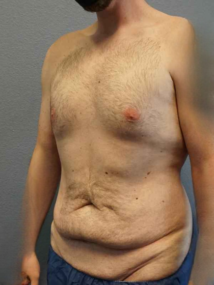 Male Liposuction Before & After Patient #3808