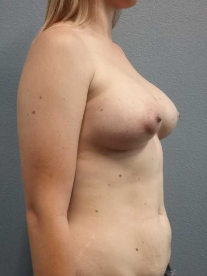 Breast Augmentation Before & After Patient #5706