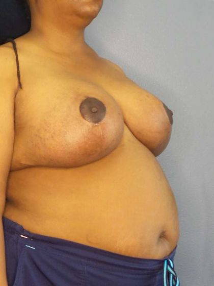 Mastopexy (Breast Lift) Before & After Patient #8402