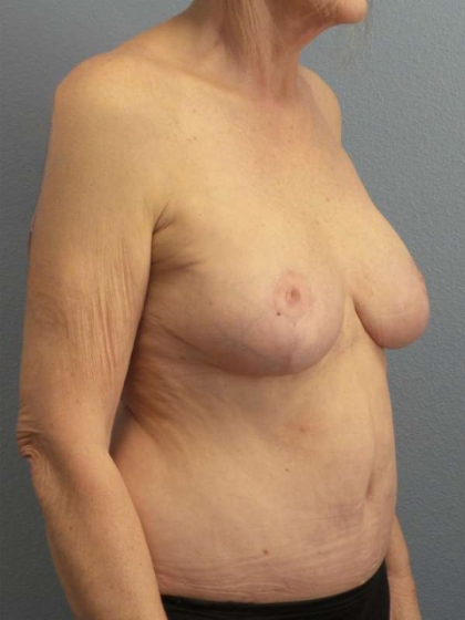 Breast Reduction Before & After Patient #7487