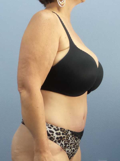 High BMI (Larger Patients) Surgery Before & After Patient #10438