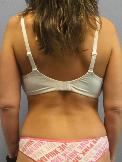 Liposuction Female Before & After Patient #8101