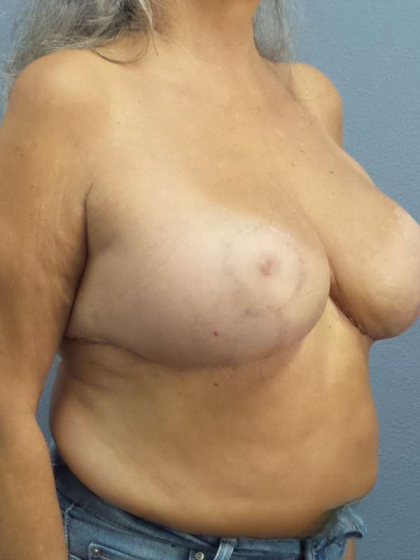 Breast Lift with Implant (Augmentation Mastopexy) Before & After Patient #3967