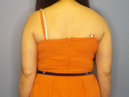 Liposuction Female Before & After Patient #7951