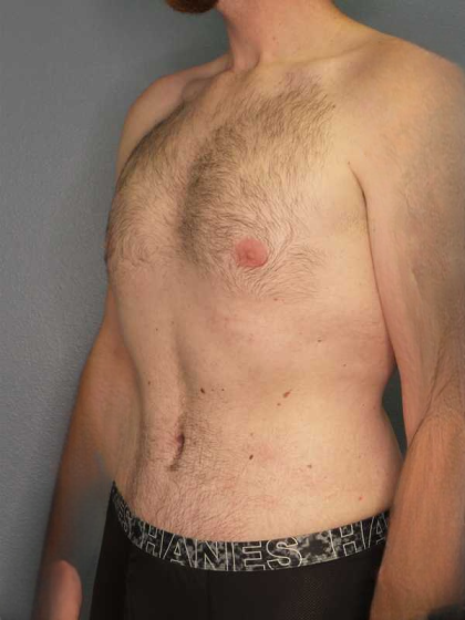 Male Liposuction Before & After Patient #3808