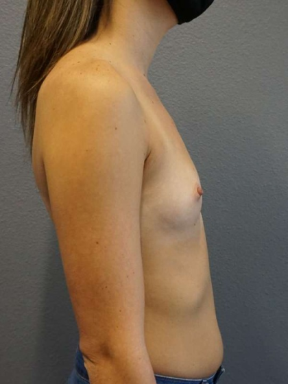 Breast Augmentation Before & After Patient #6457
