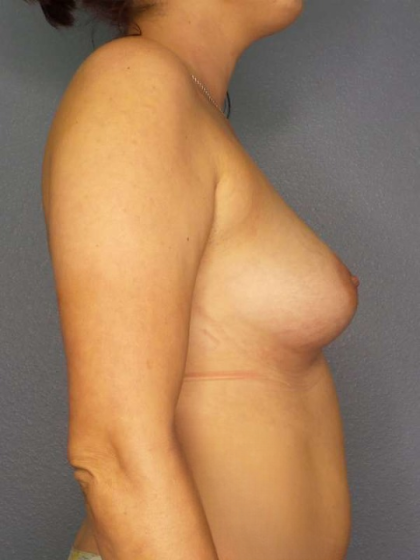 Breast Augmentation Before & After Patient #6348