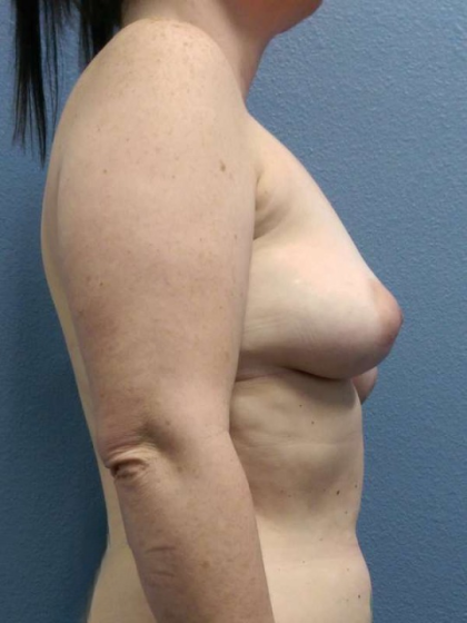 Breast Augmentation Before & After Patient #5729