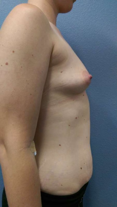 Breast Augmentation Before & After Patient #5706