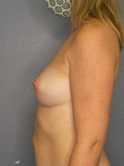 Breast Augmentation Before & After Patient #6364