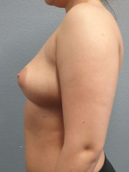 Breast Augmentation Before & After Patient #5445
