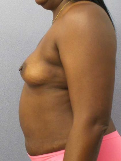 Breast Augmentation Before & After Patient #11436