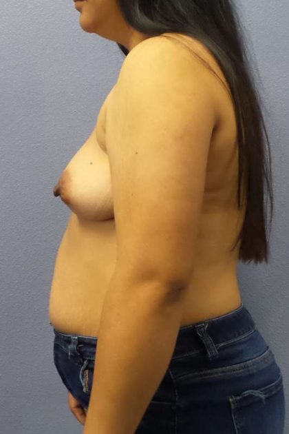 Breast Augmentation Before & After Patient #5114
